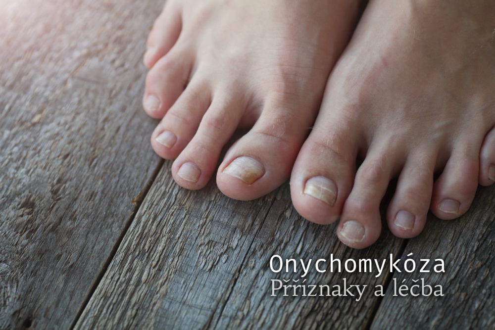 Onychomykóza